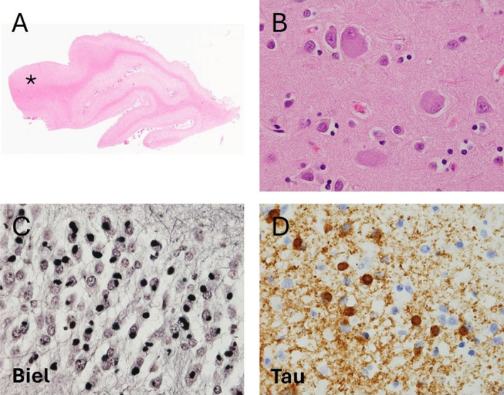 Figure 1. Pathological features of Pick’s Disease