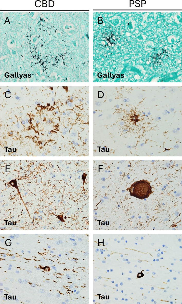 Figure 2. Pathological features of Corticobasal degeneration and
Progressive supranuclear palsy