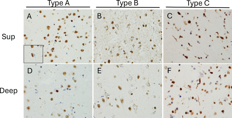 Figure 3. TDP-43 immunohistochemical features of FTLD-TDP subtypes