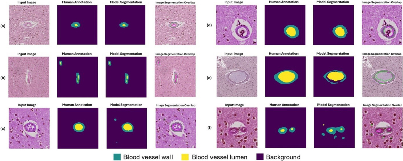 Figure 10: Example segmentation results for blood vessels with
moderate arteriolosclerosis as classified by a neuropathology fellow
(JL) and annotated by non-experts (KN, HSW, JL)