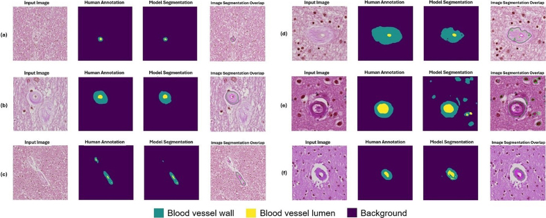 Figure 11: Example segmentation results for blood vessels with severe
arteriolosclerosis as classified by a neuropathology fellow (JL) and
annotated by non-experts (KN, HSW, JL)