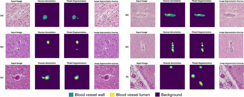Figure 12: Example segmentation results for challenging instances as
classified by a neuropathology fellow (JL) and annotated by non-experts
(KN, HSW, JL)