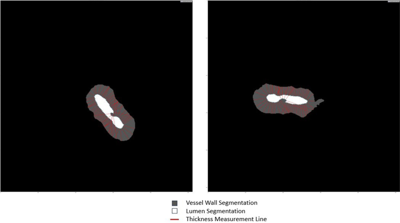 Figure 13: Involutions in the lumen contour produce inaccurate thickness
measurement lines when using the tangent line-based method