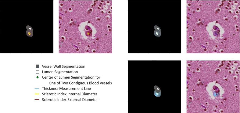 Figure 14: Images with multiple contiguous vessels pose a particular
challenge to the current version of VasMorph