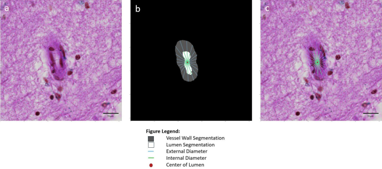 Figure 4: Sclerotic index calculation