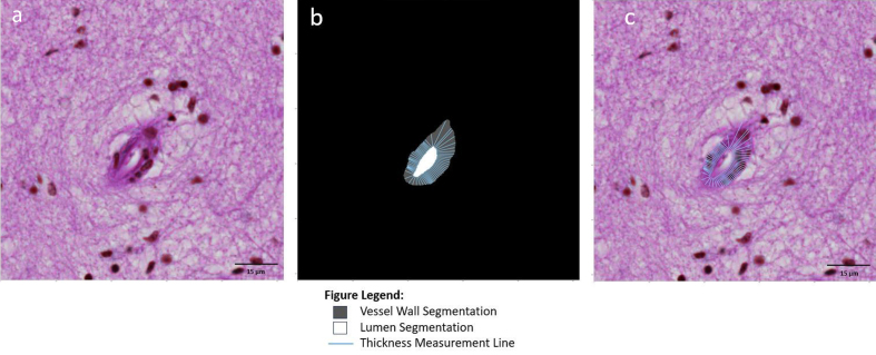 Figure 5: Vessel wall thickness based on a line tangent to every
point on the lumen contour