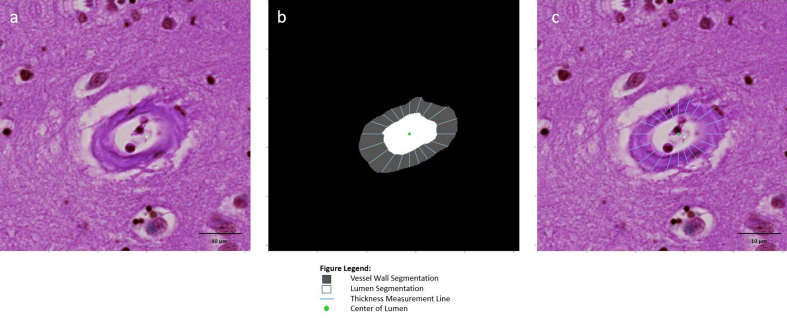 Figure 6: Vessel wall thickness based on difference between internal
and external radii
