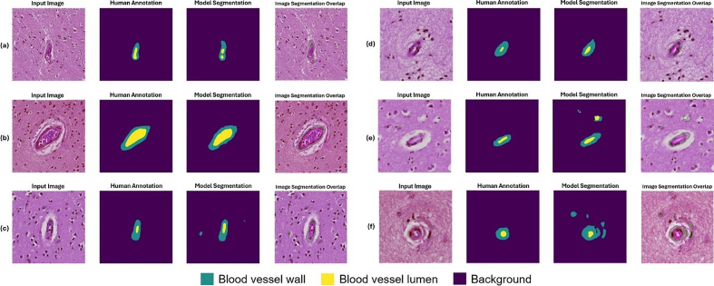 Figure 9: Example segmentation results for blood vessels with mild
arteriolosclerosis as classified by a neuropathology fellow (JL) and
annotated by non-experts (KN, HSW, JL)