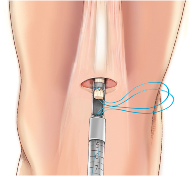 Figure 14